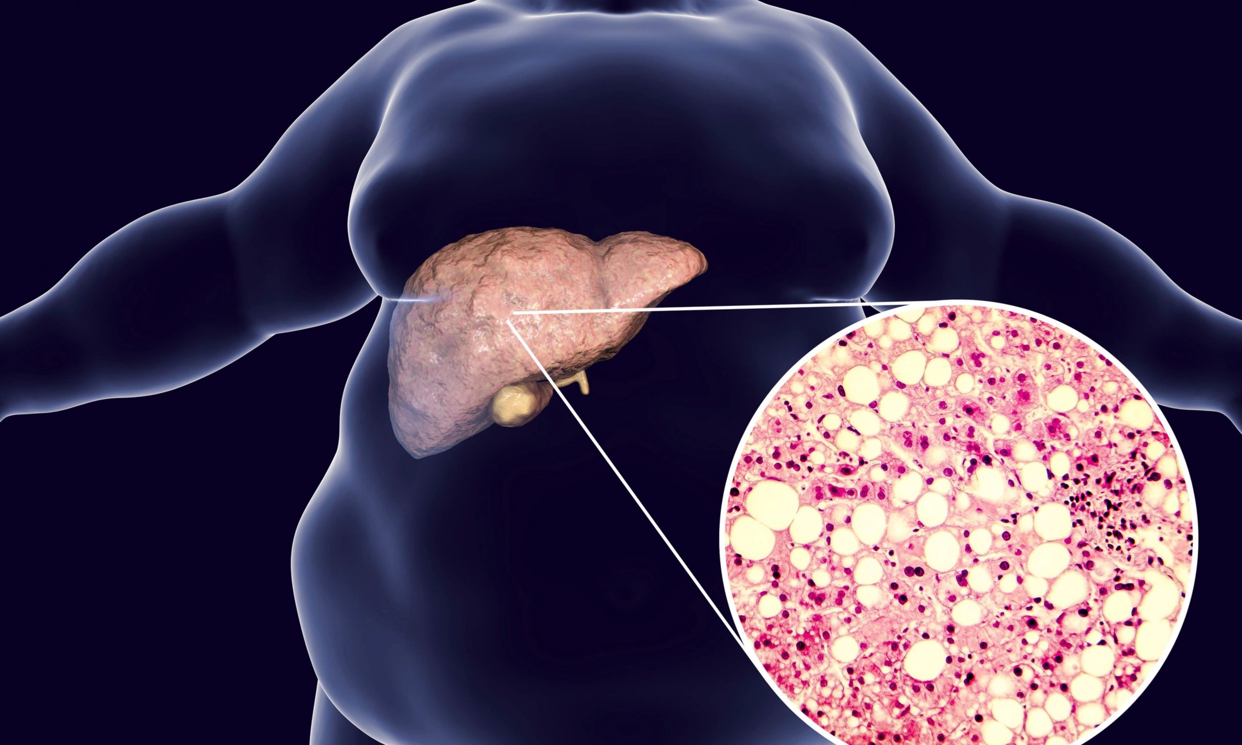 Liver health and weight management